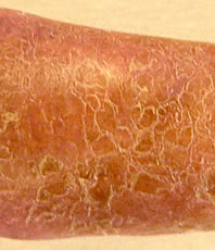 xerosis
